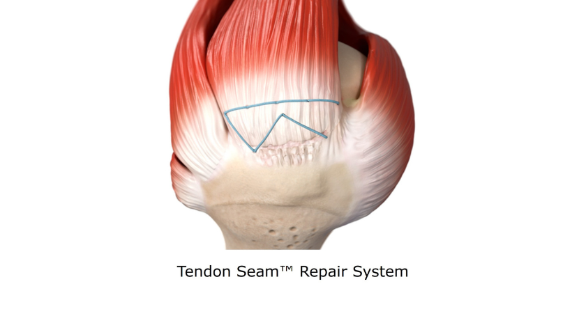Smith+Nephew Featuring Rotator Cuff Repair Portfolio at AAOS 2026